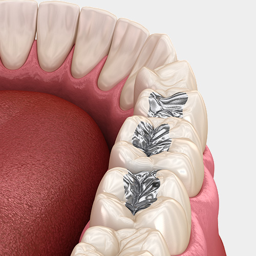 Amalgam-Füllung entfernen - Keramik - Zahnarzt Hamburg - Medi-Kuss Amalgam-Füllung entfernen - Keramik - Zahnarzt Hamburg - Medi-Kuss