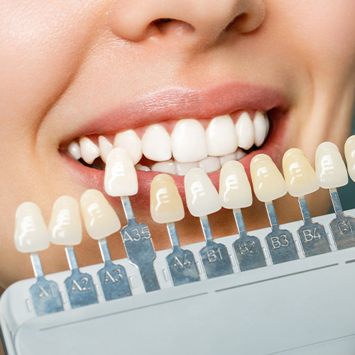 Zahnheilkunde - Veneers - Dr. Krehn - Zahnart Hamburg - Medikuss Zahnheilkunde - Veneers - Dr. Krehn - Zahnart Hamburg - Medikuss