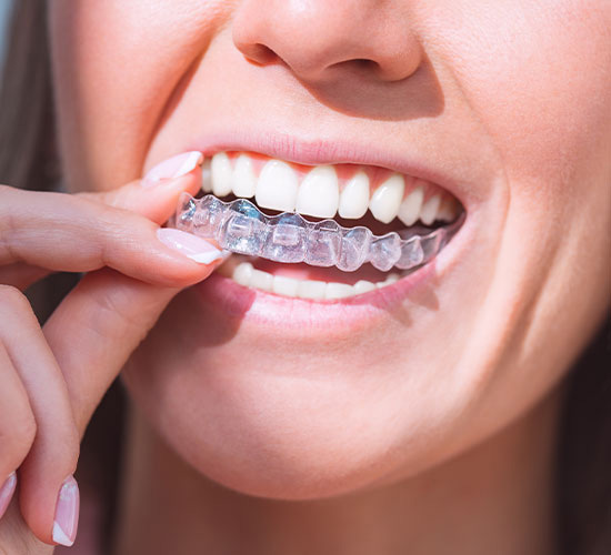 Aligner - Zahnkorrektur - Zahnarzt - Medi-Kuss - Hamburg
