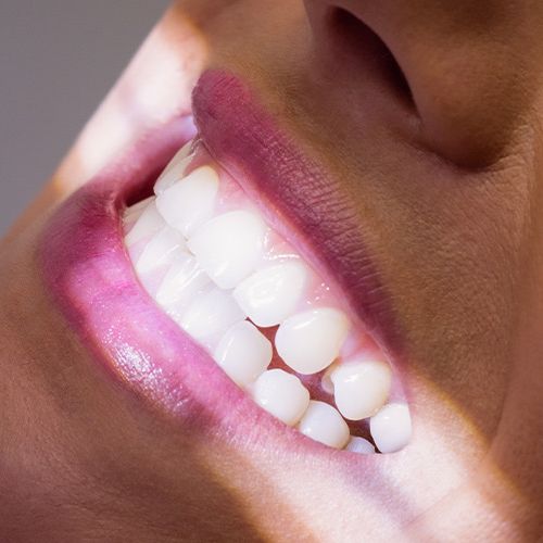Veneers - Keramik - Verblendschalen - Zahnarzt-Praxis - Medi-Kuss - Hamburg Veneers - Keramik - Verblendschalen - Zahnarzt-Praxis - Medi-Kuss - Hamburg
