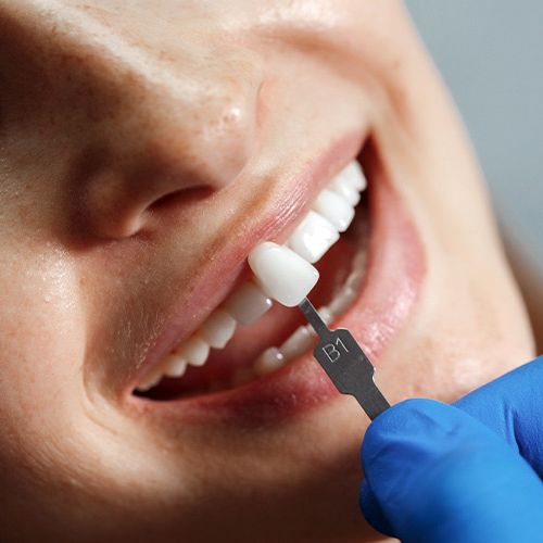 Veneers - Keramikschalen - Zahnarzt - Medi-Kuss - Hamburg Veneers - Keramikschalen - Zahnarzt - Medi-Kuss - Hamburg